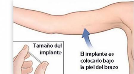 El implante hormonal, o «chip», que evita un embarazo